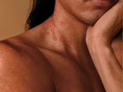 Young woman suffering itching on her arm.