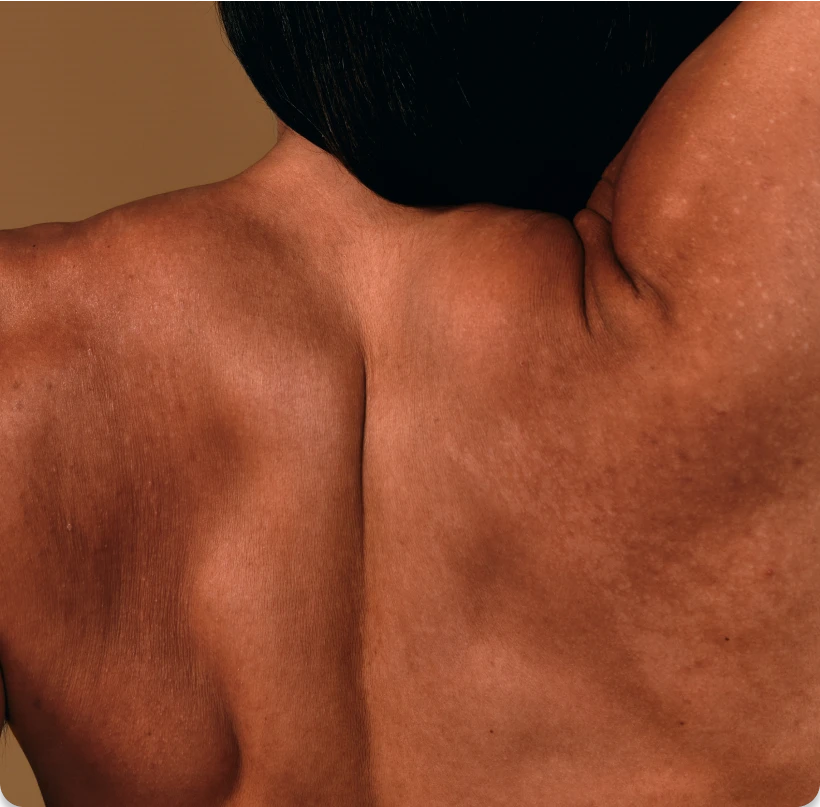 Close-up of a man's back, highlighting natural white spots in his skin. 