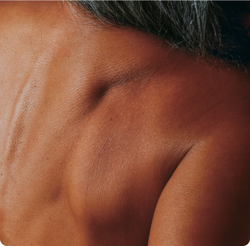 Close-up of a woman's back with natural skin, displaying signs of thinness and dehydration. 