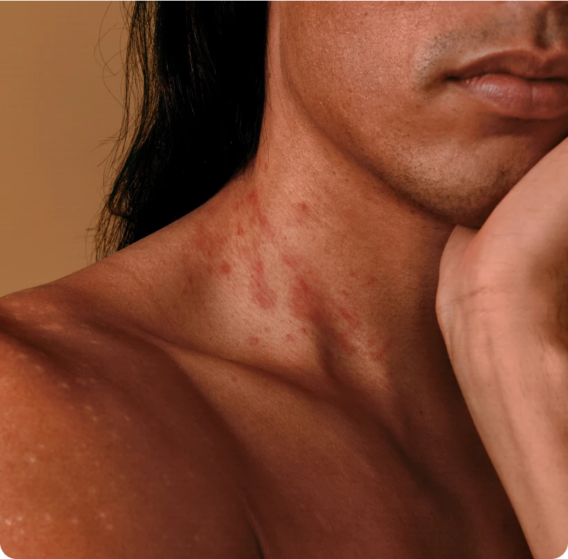 Close-up of a man's neck, revealing redness indicative of eczema, a skin condition. 